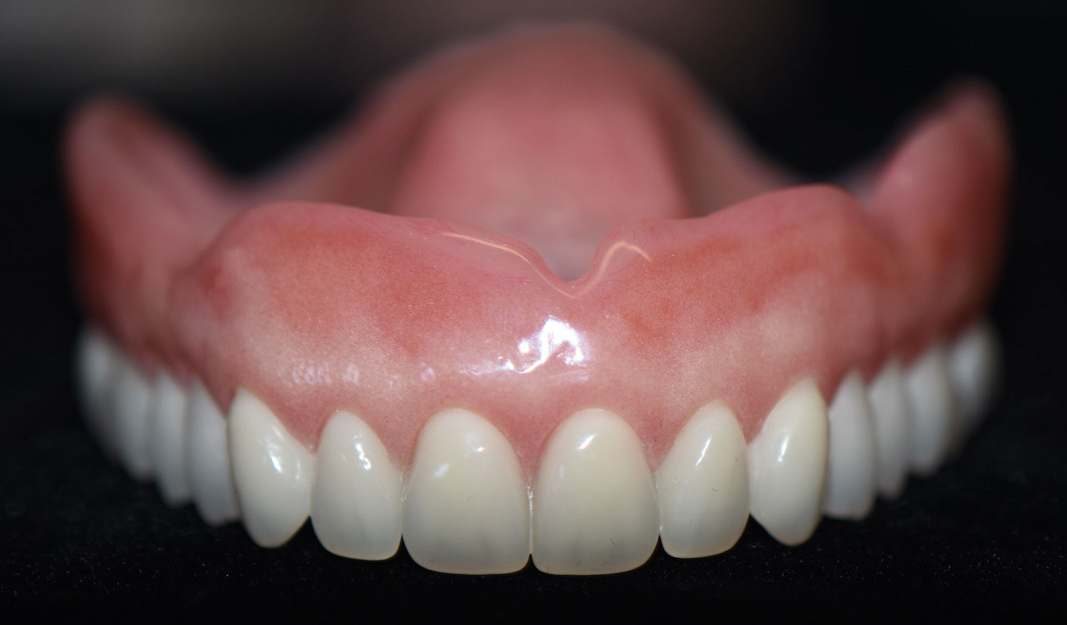 Dentures procedure, results with before/after photos of