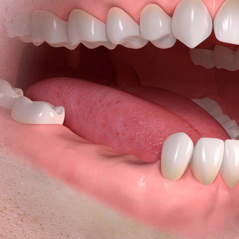 Tooth-loss