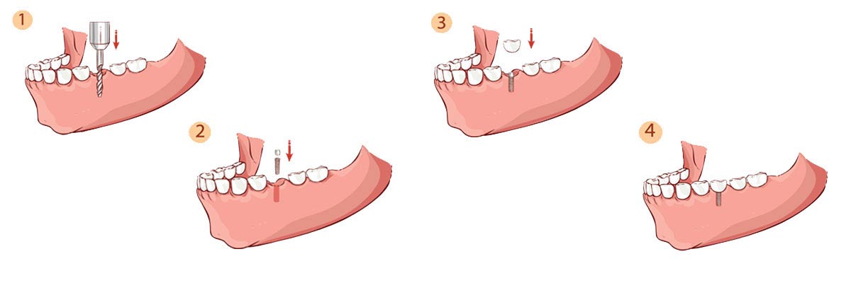 Tucson Dental Implant Restoration